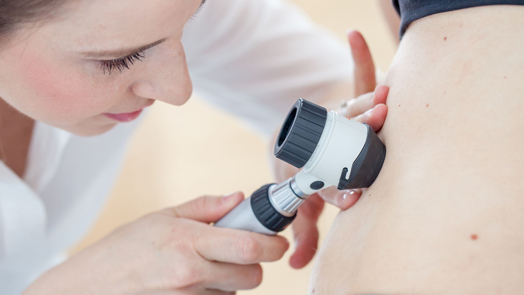 Especialistas alertan por el incremento de casos de cáncer de piel en jóvenes