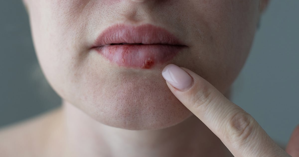 Después de casi 30 años, un comprimido nuevo vuelve a darle una oportunidad a los pacientes con herpes que se había quedado sin opciones