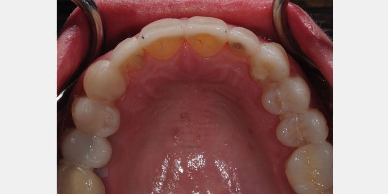 Carillas dentales: cuando el sellado se rompe y el diente queda expuesto